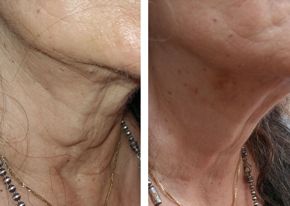 תמונות צוואר לפני ואחרי טיפול בקמטים באמצעות פרופילו